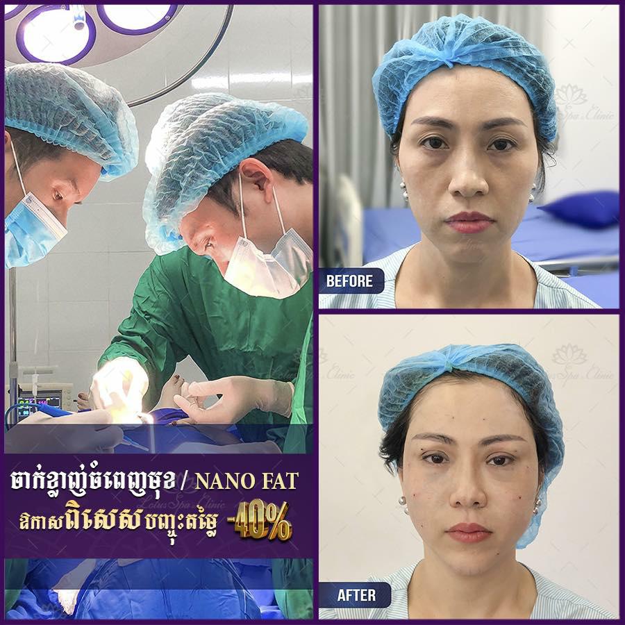 BIG PROMOTION ចាក់ខ្លាញ់បំពេញមុខ BABY